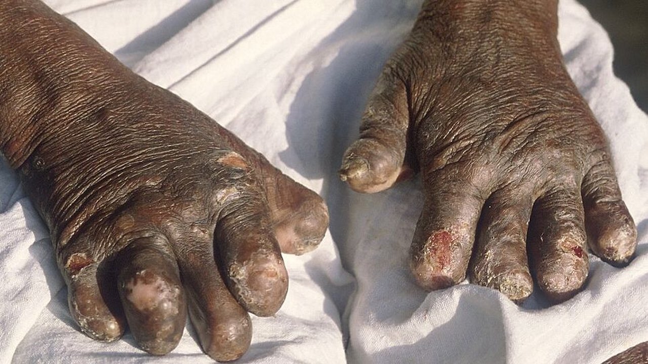 Indonesia Masih Hadapi Beban Kusta Tinggi, Pakar UGM Soroti Pentingnya Edukasi dan Deteksi Dini